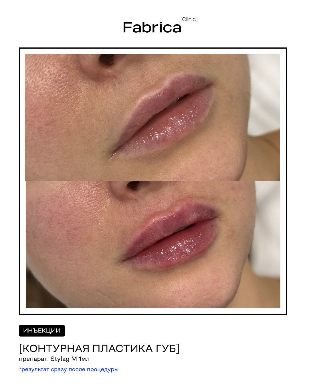 Контурная пластика губ, препарат Stylage M — Fabrica clinic