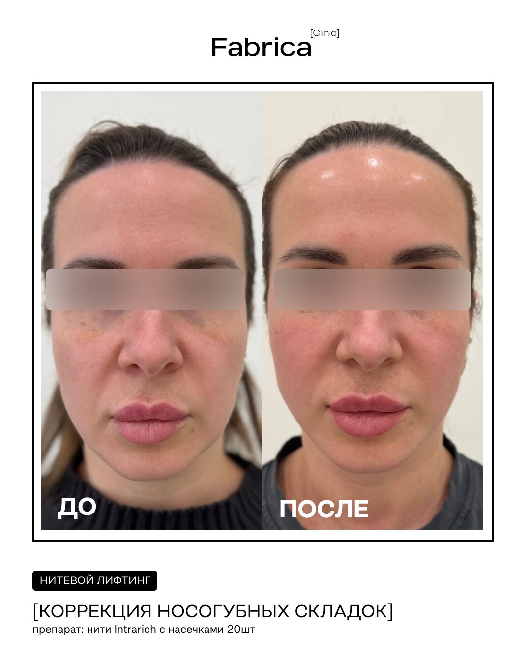 Нитевой лифтинг — коррекция средней трети лица, Fabrica clinic