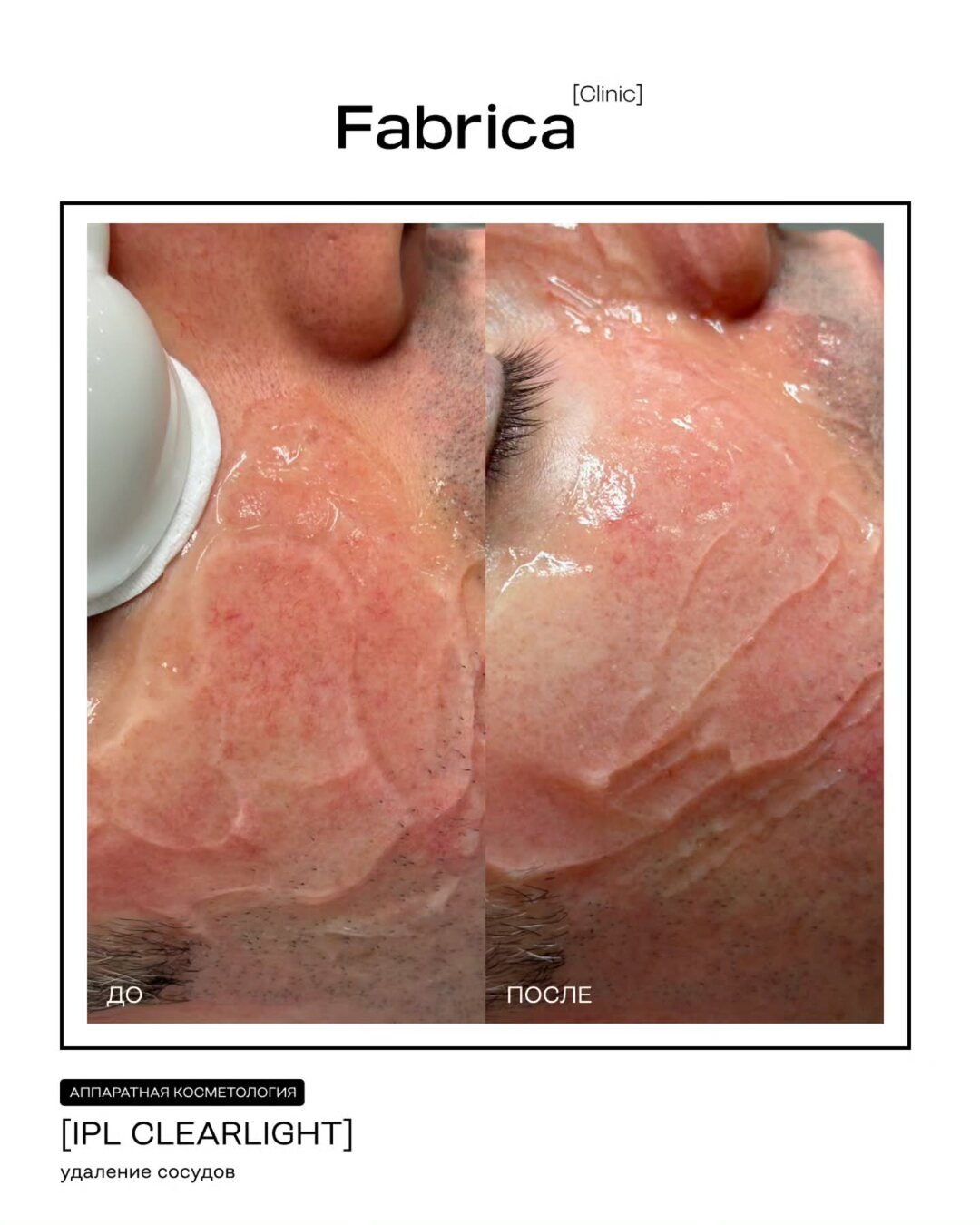 IPL Clearlight — удаление сосудов, Fabrica clinic