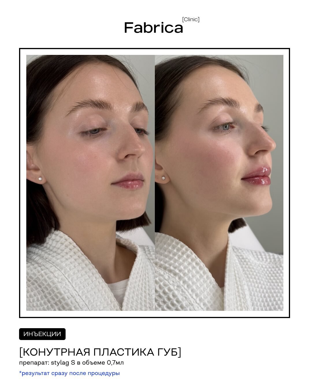 Контурная пластика губ, препарат Stylage S — Fabrica clinic
